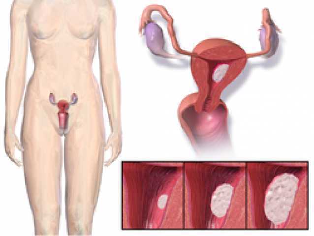 سرطان بطانة الرحم .. أعراضه وأسبابه وعلاجه والوقاية منه