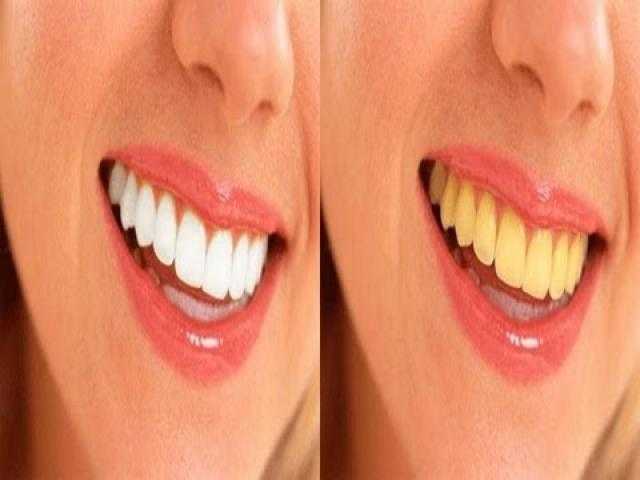 وصفات طبيعية لتبيض الأسنان