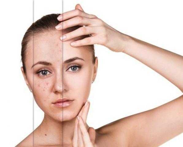 ازاى تعالج التهابات البشرة بطرق طبيعية؟