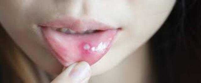 طرق علاج قرح الفم