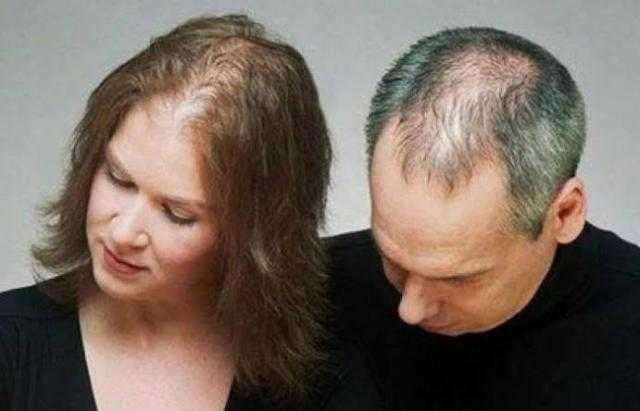 معلومات لا تعرفها عن عمليات زراعة الشعر في الدول الأوروبية