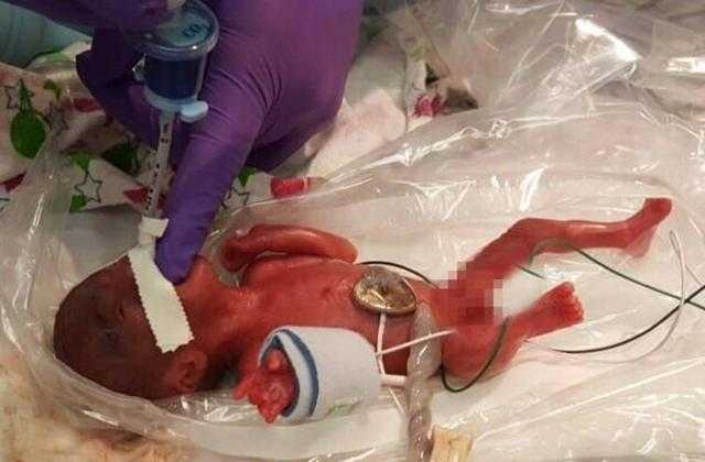 أصغر رضيعة فى العالم.. وزنها مثل تفاحة كبيرة ونجت من الموت بأعجوبة