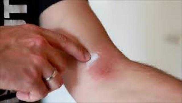 5 طرق لمنع انتشار مرض ”الصدفية”