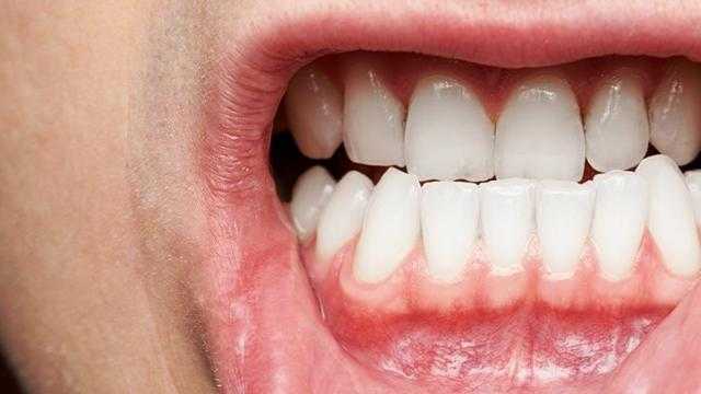 حاجات بتقولك عندك التهاب فى اللثة