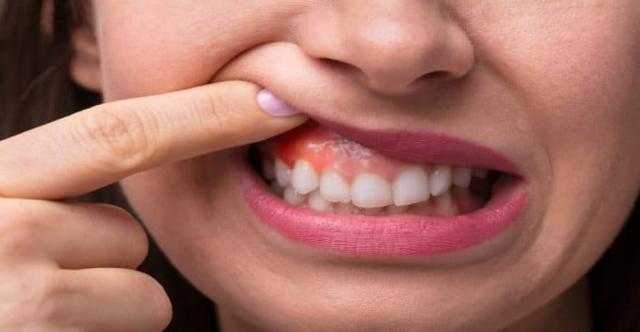 «الطبيعي يكسب».. مشروب لعلاج إلتهابات اللثة