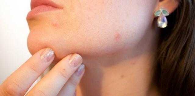 تعرفي على أكبر دليل علي وجود «تكيسات المبايض»