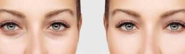 البكاء ومستحضرات التجميل الفاسدة.. 9 أسباب تورم الجفون
