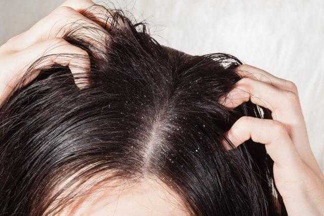تعرفى على أفضل الطرق المنزلية للتخلص من قشرة الشعر