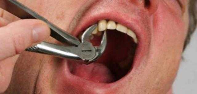 هل خلع الأسنان أثناء الصوم يفطر.. الإفتاء توضح