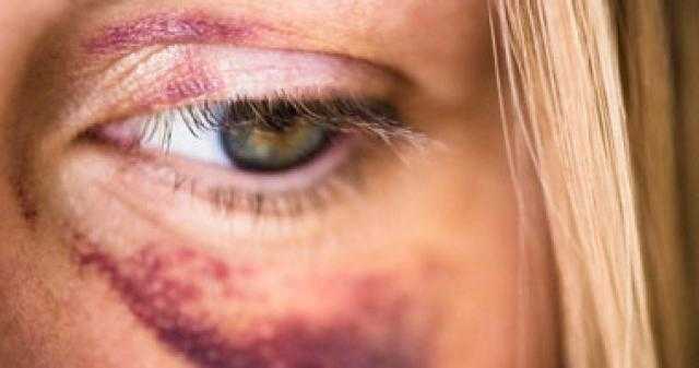دون الحاجة لطبيب.. طرق منزلية بسيطة لعلاج كدمات العين