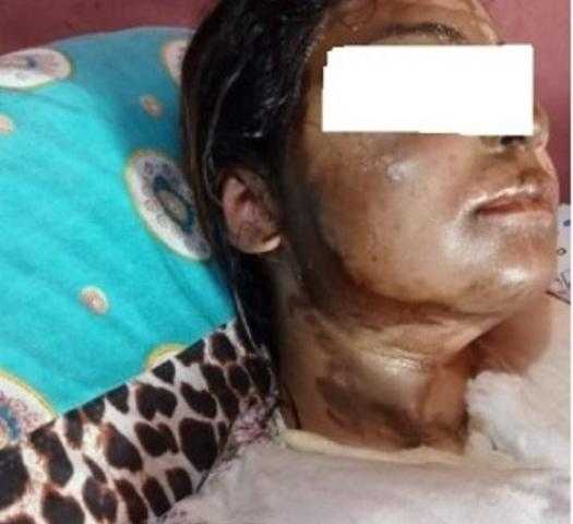 شاب يشوه وجه خطيبته لهذا السبب