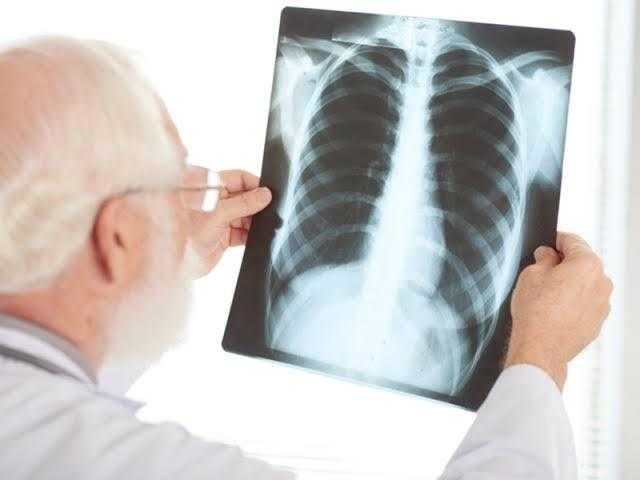 تلف الرئة لا ينتهي.. أعراض تستمر مع مصابي كورونا لأشهر
