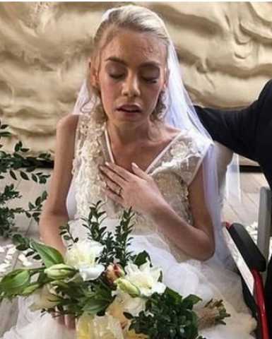 بسبب تشخيص طبي خاطئ.. فتاة تكتشف أنها مصابة بسرطان الجلد قبل زفافها بشهر
