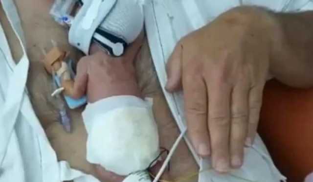 طفلة بحجم علبة الفحم تنجو من الموت بأعجوبة.. تفاصيل