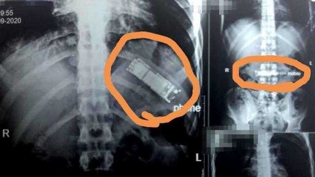 ”معدة تاكل الزلط”.. استخراج هاتف من بطن مريض ابتلعه منذ 7 أشهر