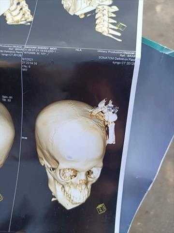 طفل يغرس مفتاح سيارة فى رأس زميله بحلوان