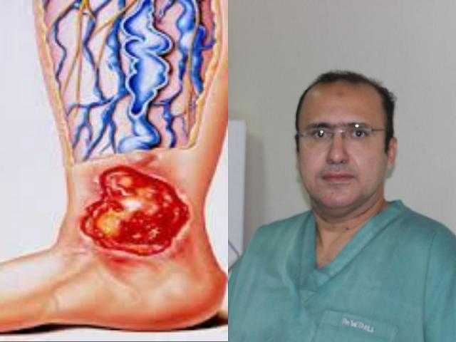 أستاذ جراحات أوعية دموية يوضح كيفية الوقاية من القرح الوريدية بالساقين