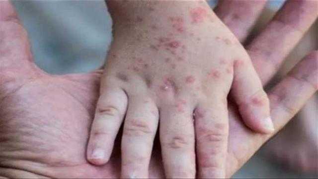 أبرز أعراض فيروس جدري القرود.. بينها الحمى والطفح الجلدي