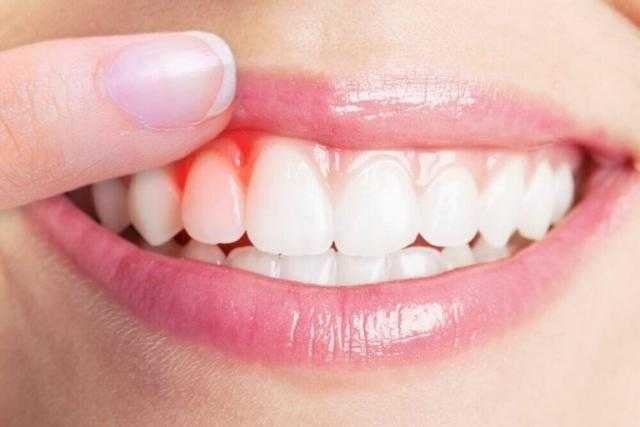 احترس من التهابات اللثة فقد تؤدي لأمراض خطيرة يجب تفاديها