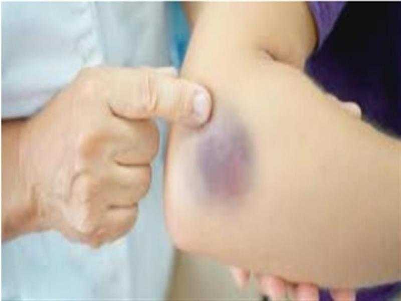 بتعانى من ظهور كدمات مجهولة على الجلد..اعرف السبب