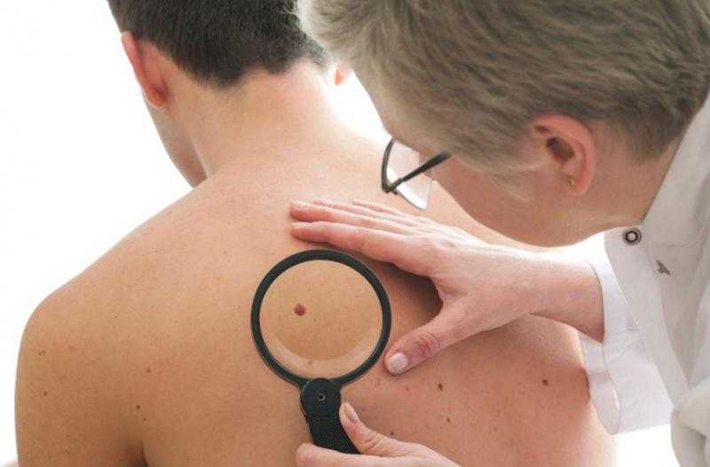 طرق علاج الزوائد الجلدية.. تعرف عليها