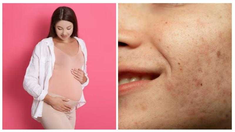 5 طرق لعلاج كلف الحمل