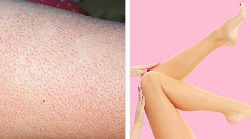 أسباب ”سيقان الفراولة”.. وكيف تتخلصين منها
