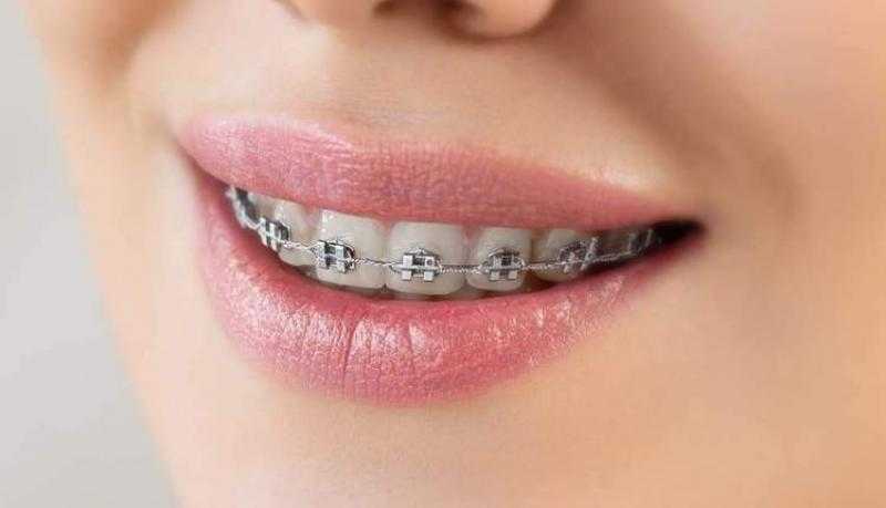 البنك الأهلي المتحد-مصر يتيح خصومات على خدمات الأسنان والتقويم في House of Braces