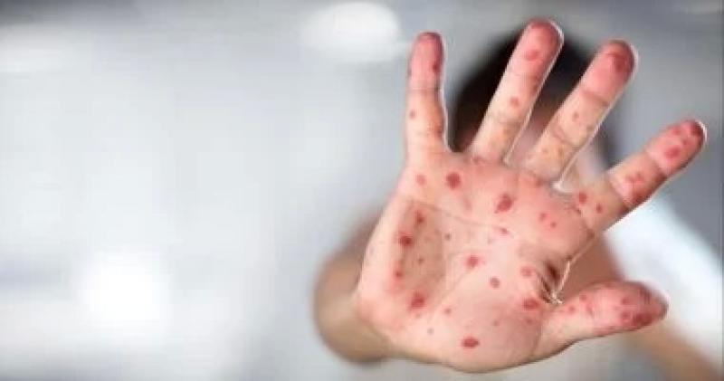 طرق التعامل الأمثل مع فيروس كوكاساكى الذى يصيب الأطفال