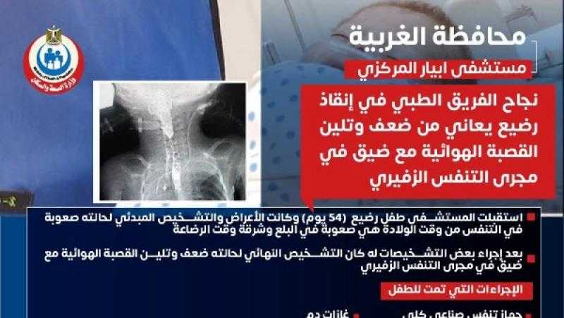 إنقاذ رضيع يعاني من ضعف وتلين القصبة الهوائية بمستشفي ابيار بالغربية