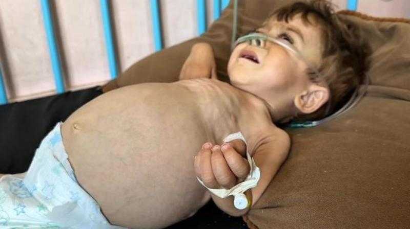 كريم.. طفل بغزة بين فكي مرض نادر وتجويع إسرائيلي