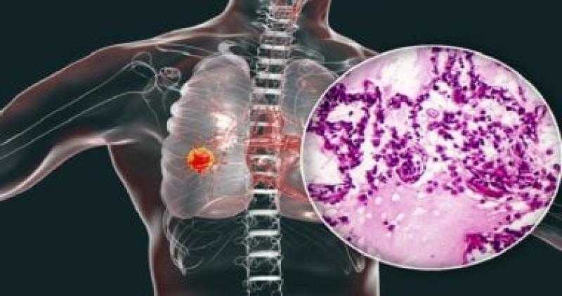 دراسة: الأطعمة المصنعة ترفع فرص الإصابة بسرطان الرئة حتى لغير المدخنين