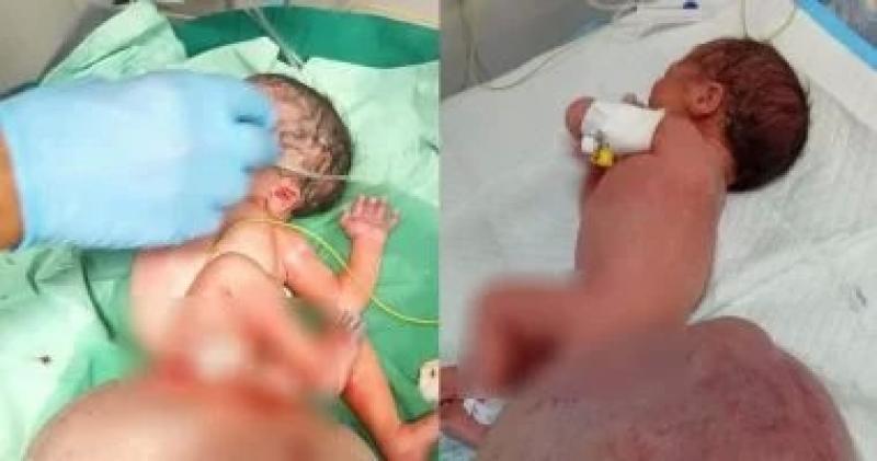 رضيعة فى غزة تصاب بتشوه خلقي لاستنشاق الأم غازات سامة