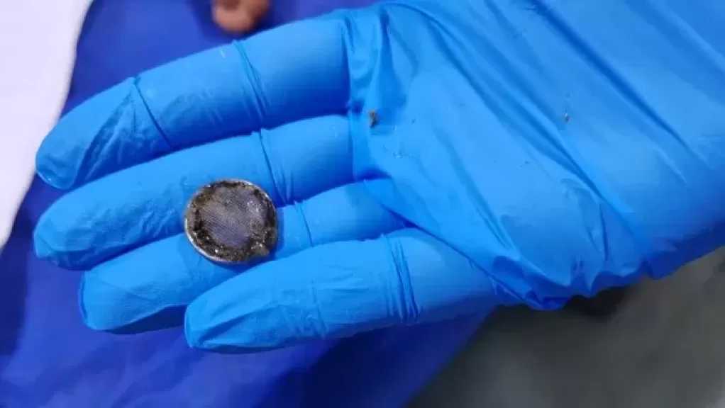 استخراج بطارية ابتلعها طفل 5 سنوات بمستشفى أبوكبير بالشرقية