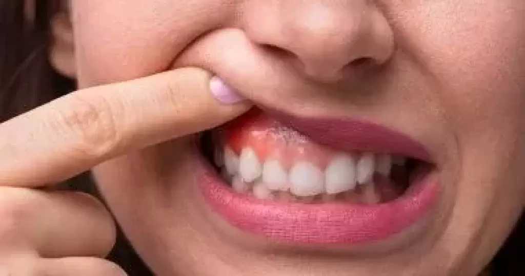 عوامل وراثية للإصابة بسرطان الفم