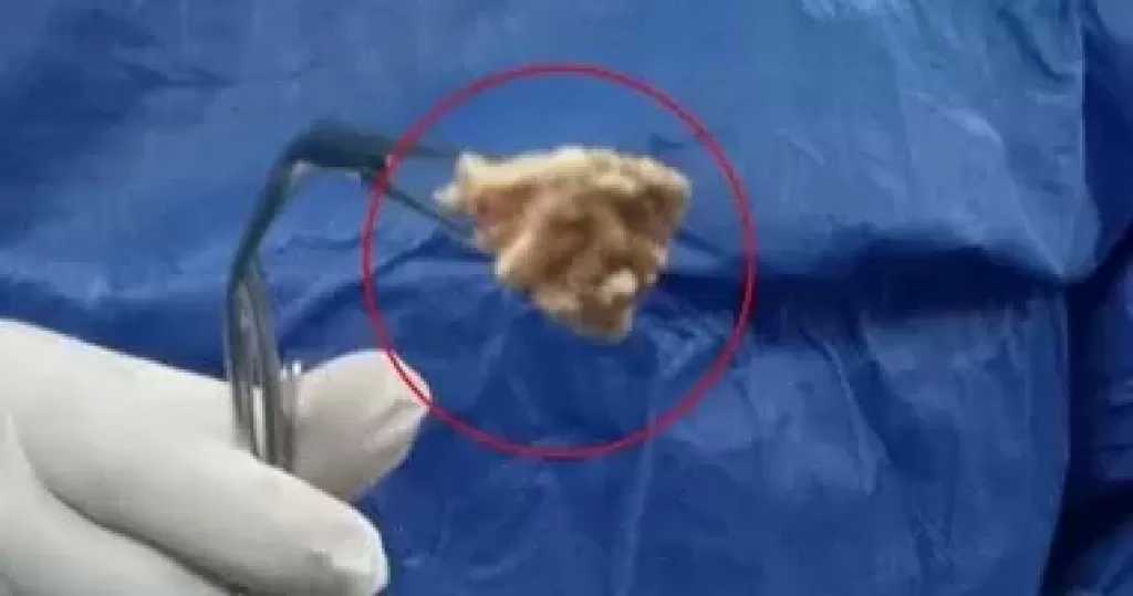 استخراج عظمة بطول 7 سم ابتلعتها طفلة من ذوي الهمم بمستشفى المنصورة الدولي