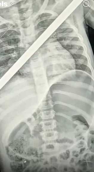 معجزة في بنها| أطباء ينتزعون سيخًا بطول 60 سم من جسد طفلة