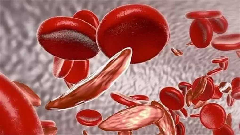 الصحة تحذر من خطورة «الأنيميا المنجلية» وتطالب المقبلين على الزواج بالفحص المبكر