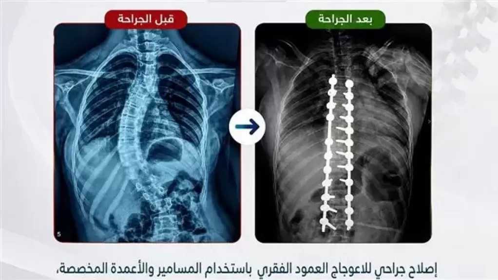 نجاح جديد في جراحات تشوهات العمود الفقري: طفلة عمرها 13 عامًا.. ”تفاصيل”