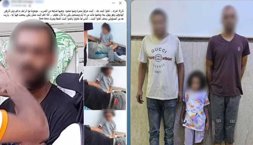 كشف ملابسات تداول صور طفلة مصابة بالإسكندرية واستغلالها في التسول