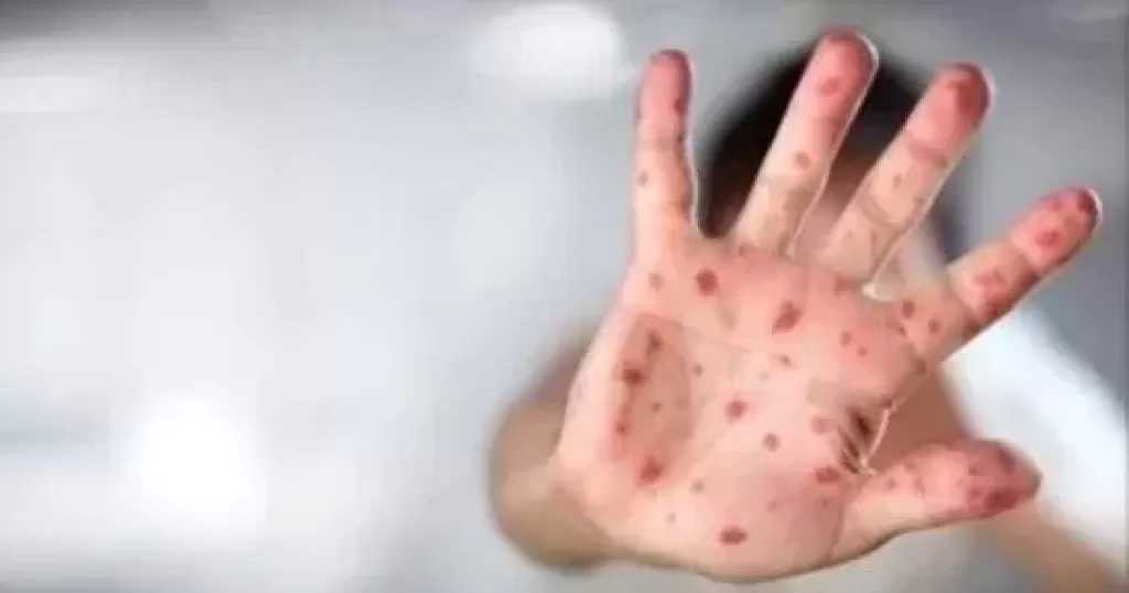 الصحة العالمية: تفشي جدري القرود المستمر يمثل حالة طوارئ من الدرجة الثالثة